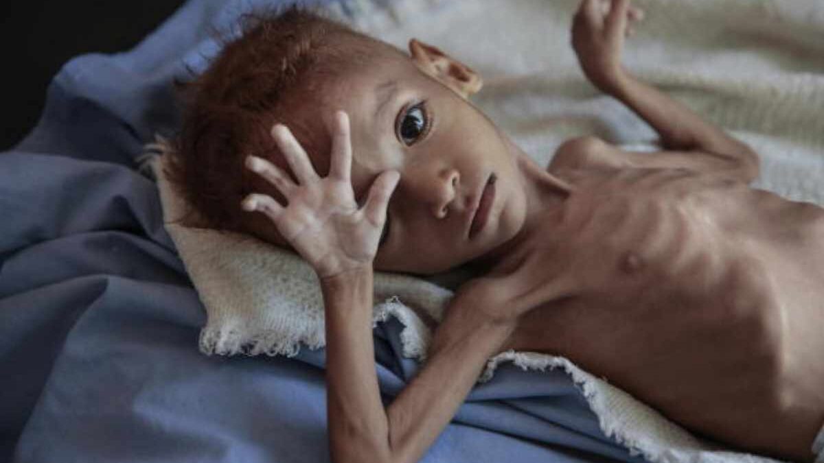 Starvation – Definition, Phases, Reasons, Symptoms, and More
